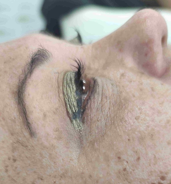 After-Eliminación Verrugas Láser