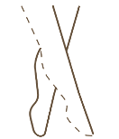 Escleroterapia-Clinic-Mallorca-MED